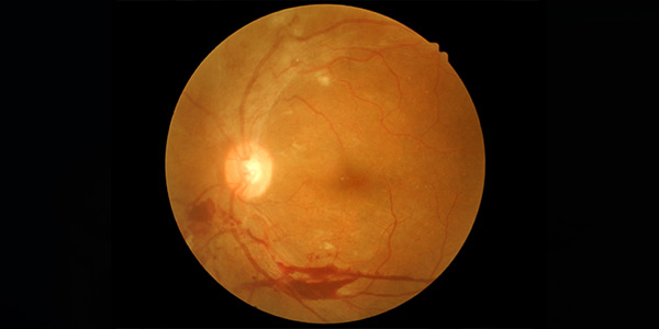 Branch Retinal Vein Occlusion (BRVO) Treatment Near Me in Connecticut Branch Retinal Vein Occlusion (BRVO) Treatment Near Me in Connecticut