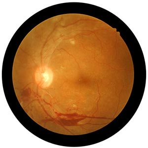 BRVO Treatment Near Me in Connecticut