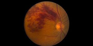 Branch Retinal Vein Occlusion (BRVO) Treatment Near Me in Connecticut Branch Retinal Vein Occlusion (BRVO) Treatment Near Me in Connecticut