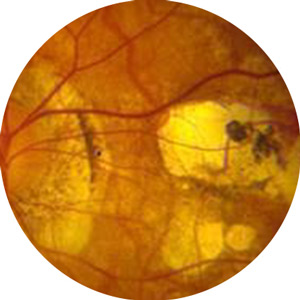 Degenerative Myopia Treatment Near Me in Connecticut