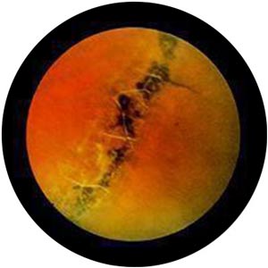 Lattice Degeneration Treatment Near Me in Connecticut