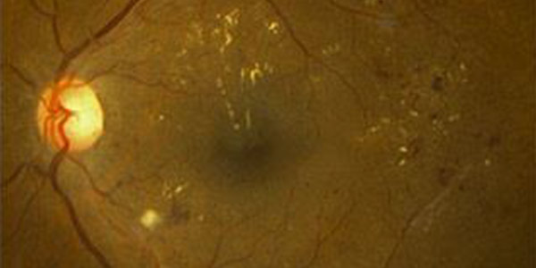 Macular Edema Treatment Specialist Near Me in Hamden, Madison, Trumbull, New Haven, Norwalk and Fairfield CT Macular Edema Treatment Specialist Near Me in Hamden, Madison, Trumbull, New Haven, Norwalk and Fairfield CT