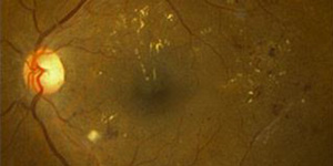 Macular Edema Treatment Specialist Near Me in Hamden, Madison, Trumbull, New Haven, Norwalk and Fairfield CT Macular Edema Treatment Specialist Near Me in Hamden, Madison, Trumbull, New Haven, Norwalk and Fairfield CT