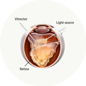 Pars Plana Vitrectomy Near Me in Connecticut