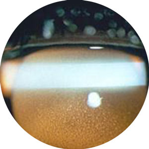 Uveitis Treatment Near Me in Connecticut